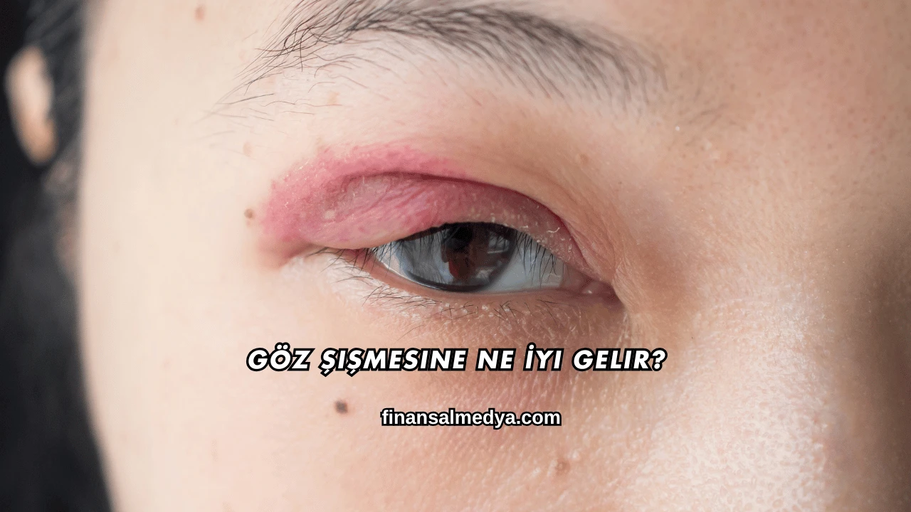Göz Şişmesine Ne İyi Gelir?