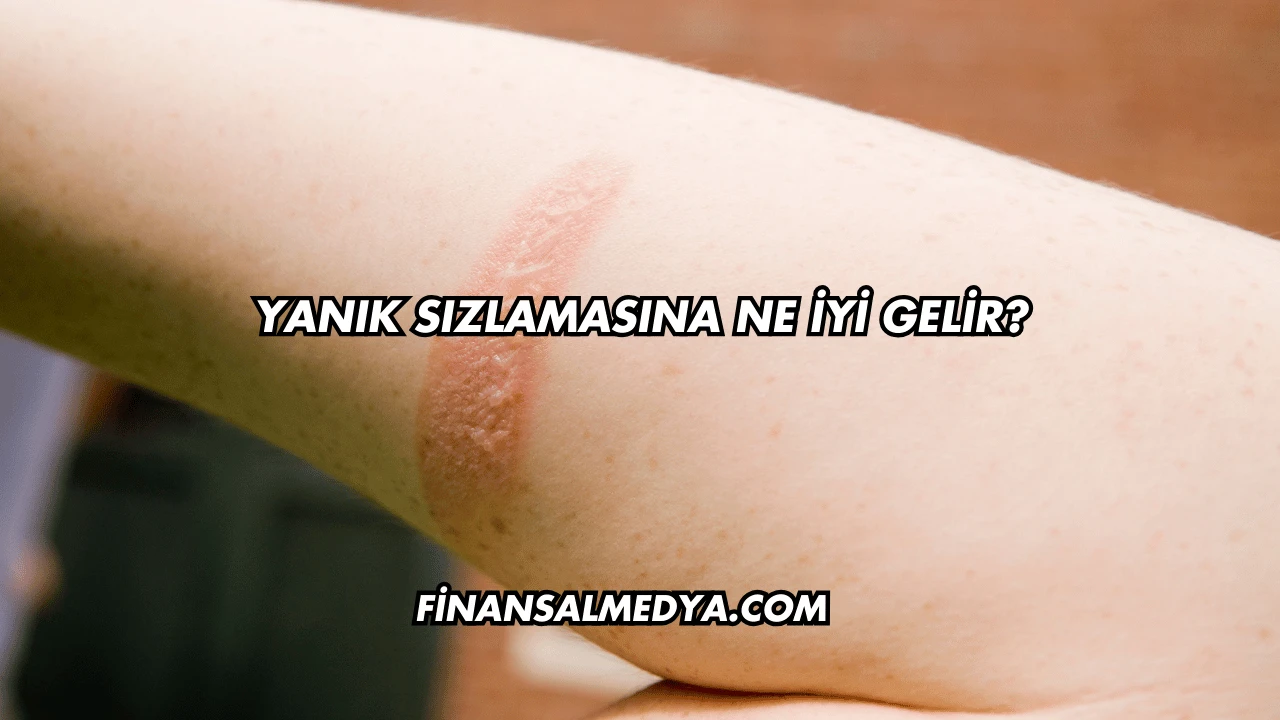Yanık Sızlamasına Ne İyi Gelir?