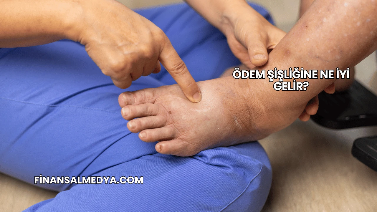 Ödem Şişliğine Ne İyi Gelir?