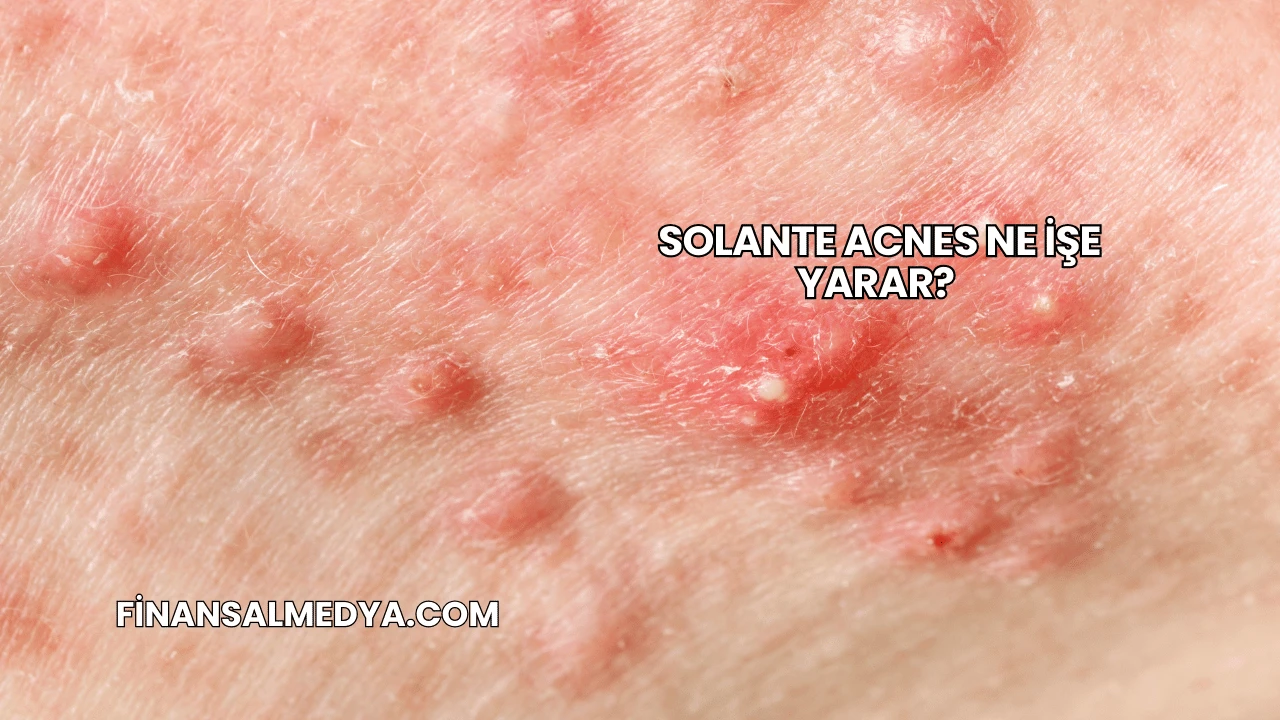 Solante Acnes Ne İşe Yarar?
