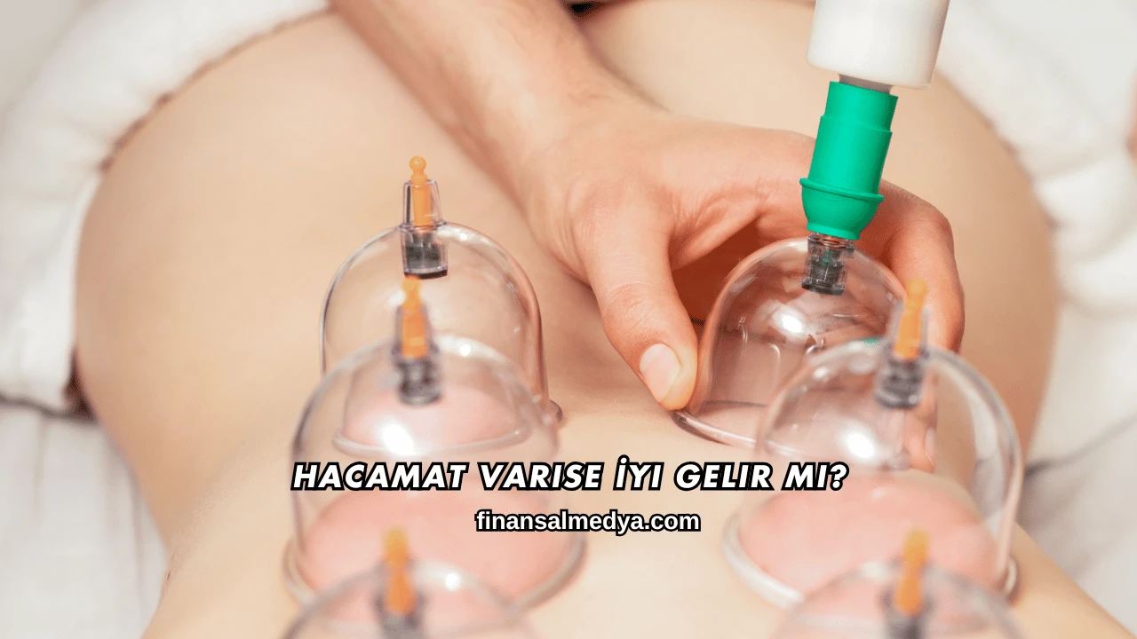 Hacamat Varise İyi Gelir mi?