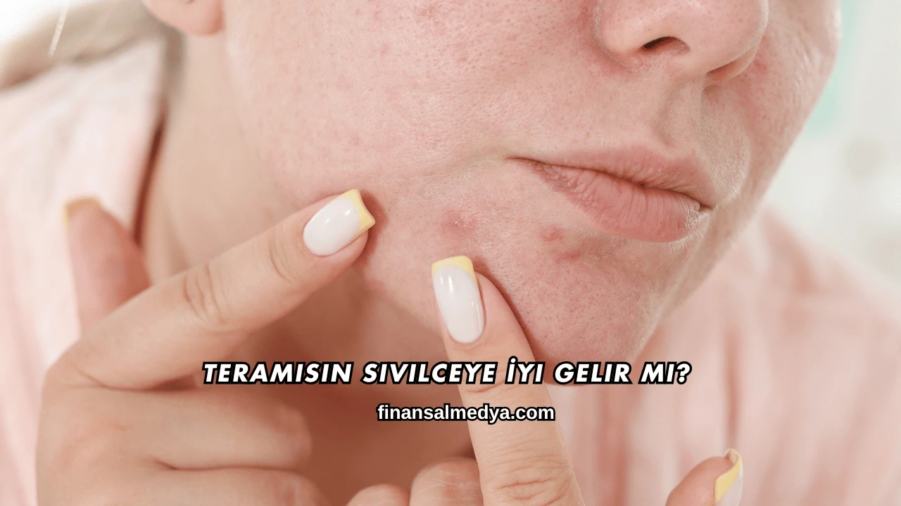 Teramisin Sivilceye İyi Gelir mi?