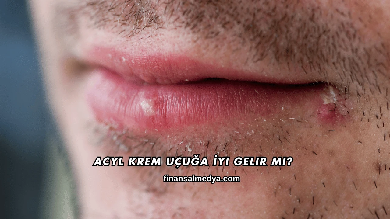 Acyl Krem Uçuğa İyi Gelir mi?