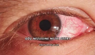 Göz Nezlesine Ne İyi Gelir?