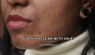 Yüzdeki Sivilcelere Ne İyi Gelir?