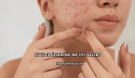 Sivilce İzlerine Ne İyi Gelir?