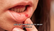 Ağız İçi Yarasına Ne İyi Gelir?