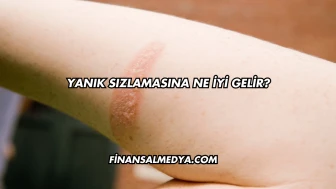 Yanık Sızlamasına Ne İyi Gelir?