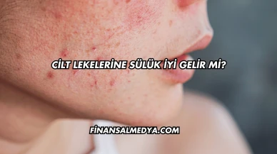 Cilt Lekelerine Sülük İyi Gelir mi?