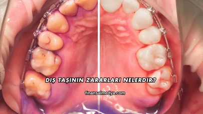 Diş Taşının Zararları Nelerdir?