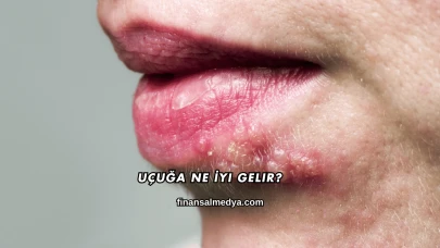Uçuğa Ne İyi Gelir?