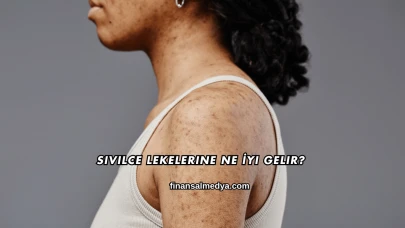 Sivilce Lekelerine Ne İyi Gelir?
