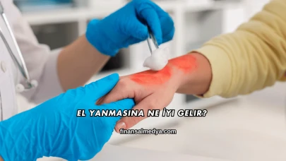 El Yanmasına Ne İyi Gelir?