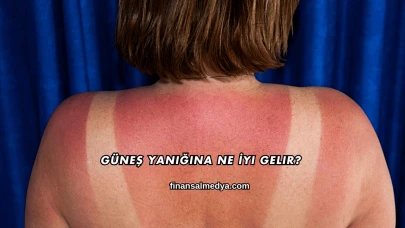 Güneş Yanığına Ne İyi Gelir?