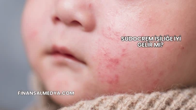 Sudocrem İsiliğe İyi Gelir mi?