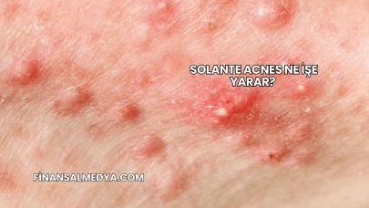 Solante Acnes Ne İşe Yarar?