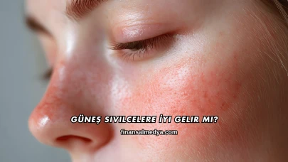Güneş Sivilcelere İyi Gelir mi?