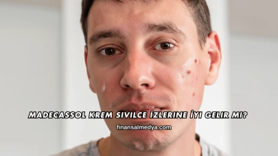 Madecassol Krem Sivilce İzlerine İyi Gelir mi?