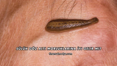 Sülük Göz Altı Morluklarına İyi Gelir mi?