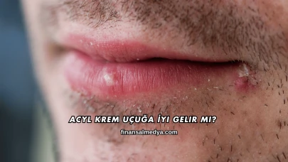 Acyl Krem Uçuğa İyi Gelir mi?