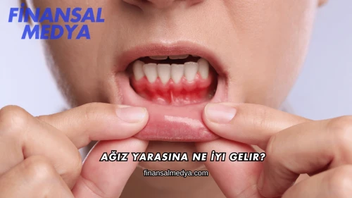 Ağız Yarasına Ne İyi Gelir?