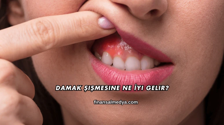 Damak Şişmesine Ne İyi Gelir?