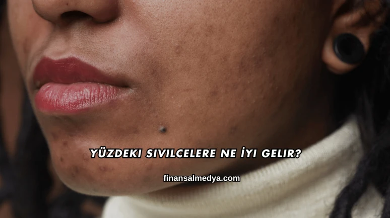 Yüzdeki Sivilcelere Ne İyi Gelir?
