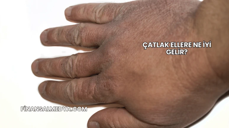 Çatlak Ellere Ne İyi Gelir?