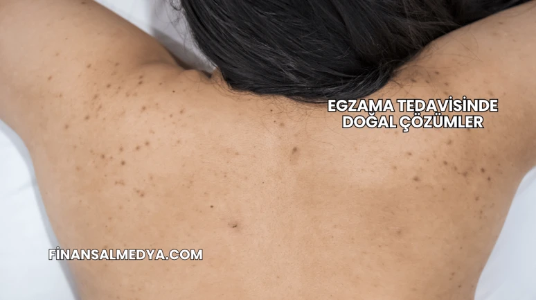 Egzama Tedavisinde Doğal Çözümler
